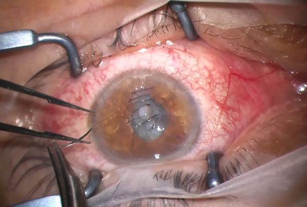 Video of the month | May 2024 | Surgical management of extensive corneal laceration, traumatic cataracts and intraocular foreign bodies - Ocular integrity first